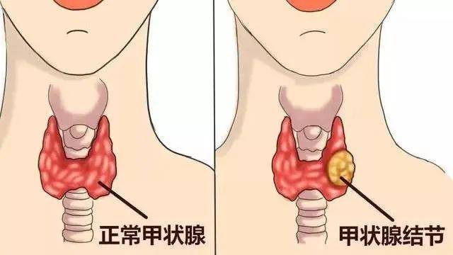 情绪 甲状腺情绪与甲状腺健康，揭秘二者之间的微妙联系